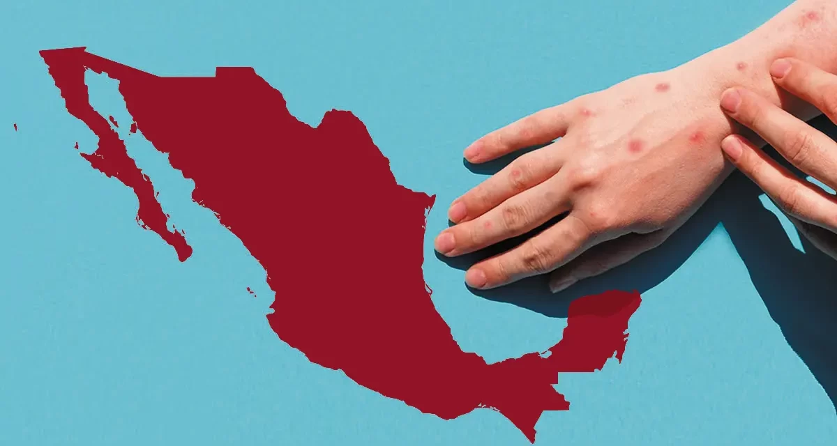 El regreso del sarampión, gracias a AMLO